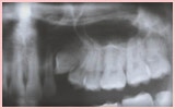 X光片上阻生牙的情形