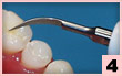 4. 頜面：牙尖或窩溝內的水門汀，線型接觸。