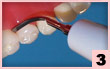 3. 齶側面：齦上大塊結石，前端接觸，並根據牙齒形狀改變角度。