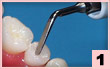 1. 頜面：牙尖或窩溝內牙垢及煙垢清除，線型接觸。