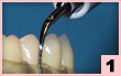 1. 頰側面：齦上牙結石清除及牙周囊袋清潔，線型接觸。