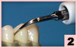 2. 唇側面：側牙及狹窄區域結石清除，線型接觸。