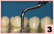 3. 頰側面：雙重作用：平整根面骨質及牙本質，清潔牙齦溝。