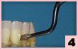 4. 唇側面：牙周袋潔治及鄰間面潔牙。