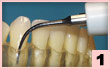 1. PFU-唇側面：小塊齦下結石，去除菌斑，線型接觸。