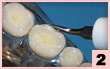 2. PFL-頰側面：精細牙間隙潔治，適用於磨牙及前磨牙，線型接觸。