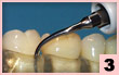 3. PFR-頰側面：中度牙周袋的潔治，沖洗，線型接觸。