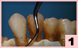 1. H3-頰側面：深度牙周袋潔治，去除內毒素及壞死組織（通用工作尖）。