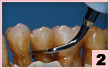 2. H4R-頰側面：牙間隙緊密接觸區的根面平整。