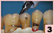 3. H4R-舌側面：難以達到的區域，牙根部治療。