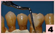 4. H4R-頰側面：（深牙周袋）根分歧處精細潔治及根面平整。