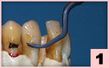 1. PA1-頰側面：牙周治療後牙頸部的精細拋光。