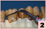 2. PB2L-頰側面：根面平整後的精細拋光及保守治療，牙間隙區。