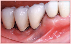 牙周護理 牙周工作尖（軟質） - 植體清潔與維護