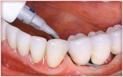 牙周護理 牙周工作尖（軟質） - 植體清潔與維護