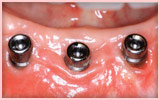 牙周護理（軟質） - 植體清潔與維護