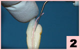 2. SO4：將主牙膠尖放入根管，距根尖孔1mm處插入牙膠充填工作尖。