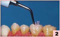 2. SO7：多支牙膠尖充填，牙膠尖被超聲振動的機械和熱效應所軟化，牙膠尖熔化為堅實均勻的整體。