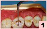 1. ET 40：通過去除周邊壞死組織而取出牙膠尖或銀針。
